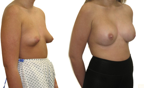 before and after photographs of breast correction surgery of tubular breasts