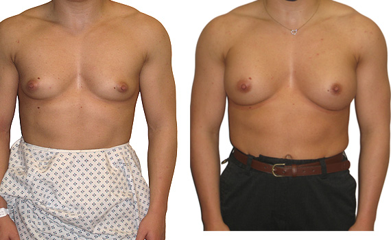 Before and after photo of breast enlargement performed by Mr Hassan Shaaban