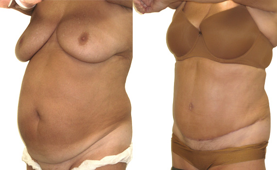 photograph of before and after face lift surgery