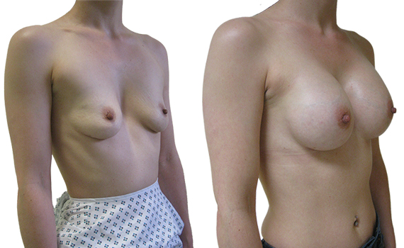 before and after photographs of breast enlargement surgery by surgeon Hassan shaaban Aset Hospital  Liverpool  