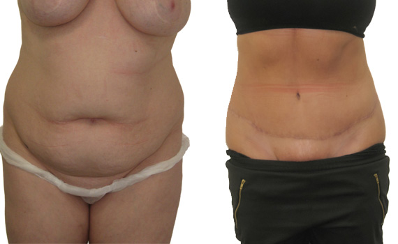 Abdominoplasty (Tummy Tuck) before and after image