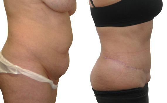 before and after photograph of a extended abdominoplasty performed by consultant plastic surgeon Hassan Shaaban