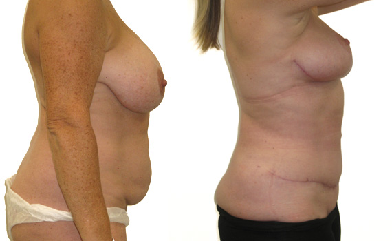 before and after gallery photos of breast asymetry operation by mr hassan shaaban cosmetic surgeon
