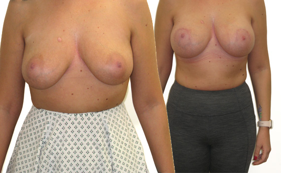 photos of BBA and nipple lift before and after surgery.
