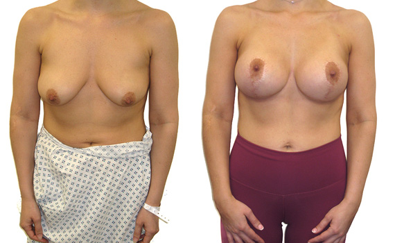 before and after photographs of breast uplift surgery by surgeon Hassan shaaban Aset Hospital  Liverpool  