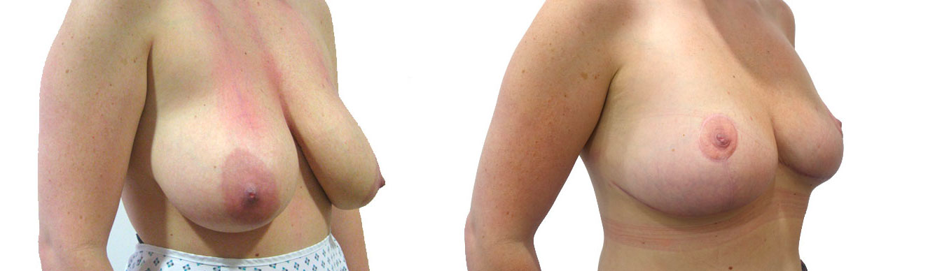the results showing breasts before and after  a breast reduction procedure - reduction mammplasty - surgeon Mr Hasan Shaaban