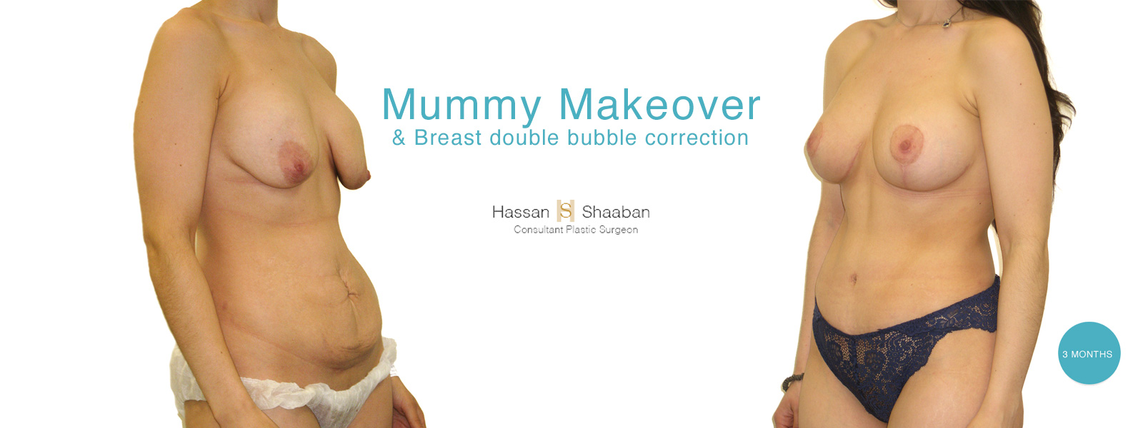 mummy makeover before and after surgery before and after at 3 months