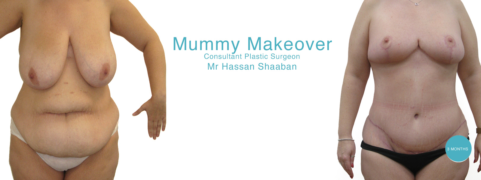 mummy makeover before and after surgery by the best mummy makover surgeon plastic surgeon Mr Hassan Shaaban