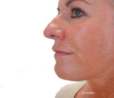 face lift improving the signs of aging in the neck and face surgery by cosmetic face surgeon h shaaban 